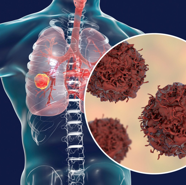 anatomy of lung cancer from inside body