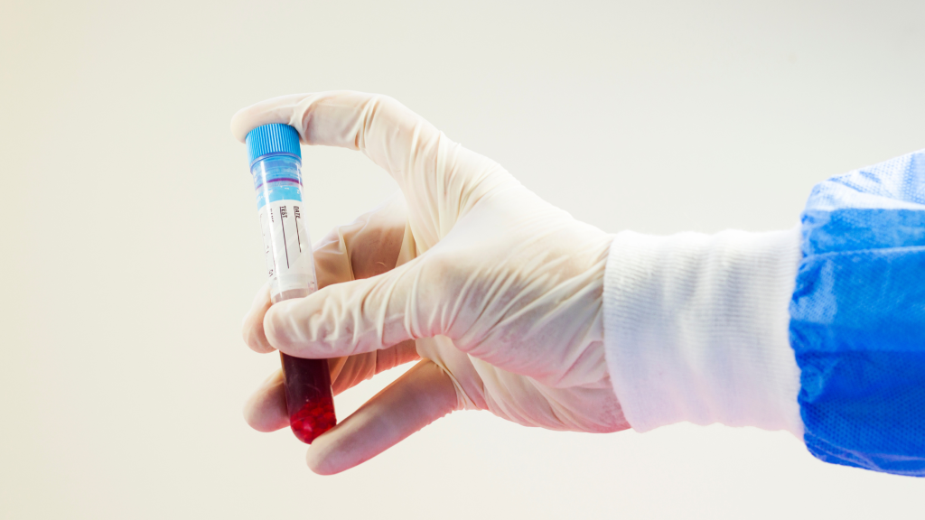 a blood sample for confirming mcv high blood test