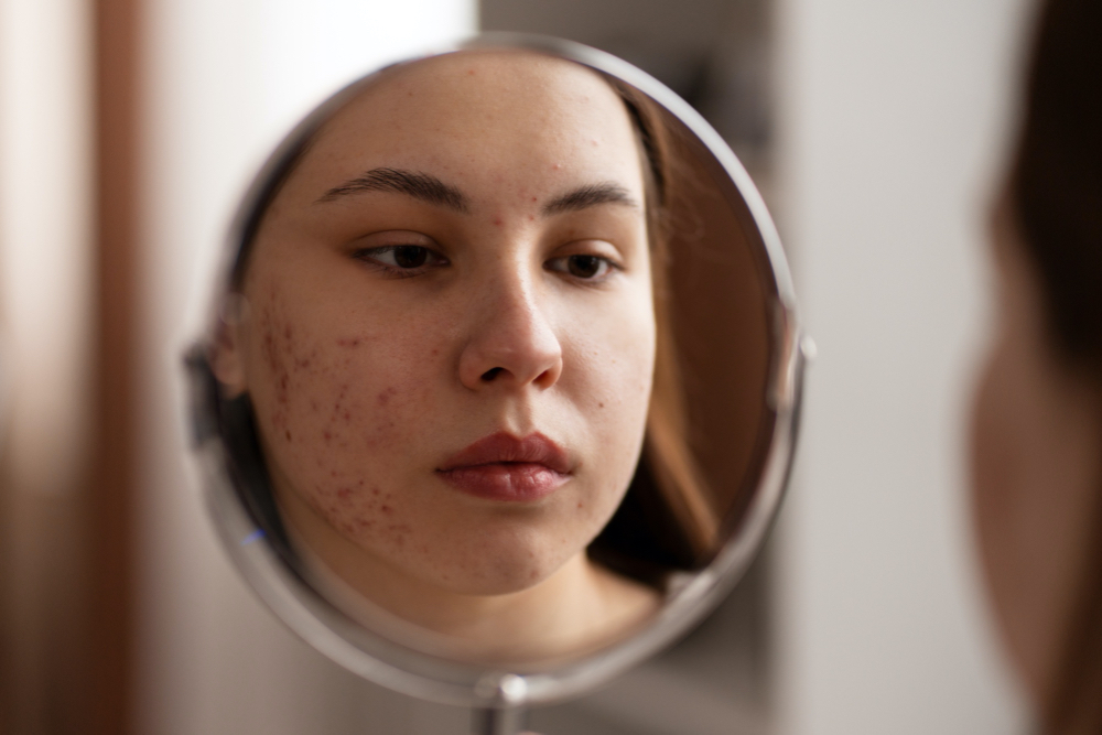 woman dealing with acne